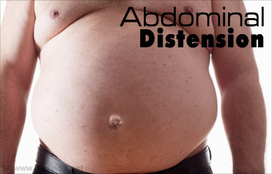 abdominal-distension.jpg