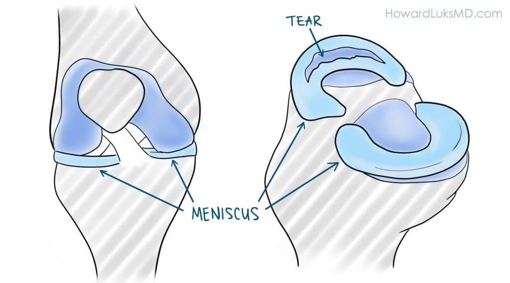 Bucket-Handle-meniscus-tear.jpg